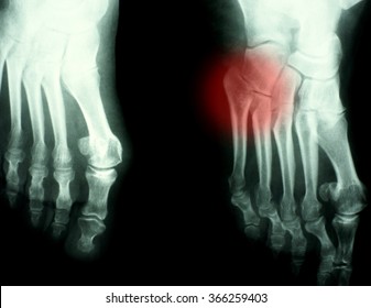 Foot Xray (X-ray) Photo