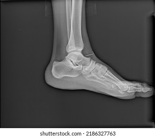 Foot Xray Showing Broken Needle Foreign Stock Photo 2186327763 ...