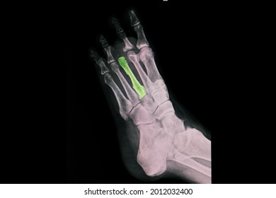 A Foot Xray Showing Surgical Amputation Of Third Toe At Metatarsal Joint.