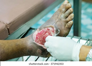  Foot,treating Patients With Foot Ulcers,Diabetic Foot Ulcer