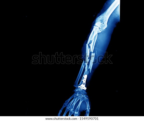 forearm and wrist x-ray showing severe and\
comminution fracture at both radius and ulnar bones. The patient\
also had compartment syndrome at the forearm. He needs fasciotomy\
and internal fixation.