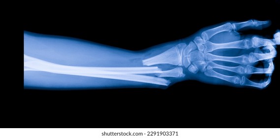 Forearm x ray after car accident in orthopedic unit inside trauma hospital.X-ray shows radius and ulna bone fracture.Patient needs surgery.Xray technology in blue on black background. - Shutterstock ID 2291903371