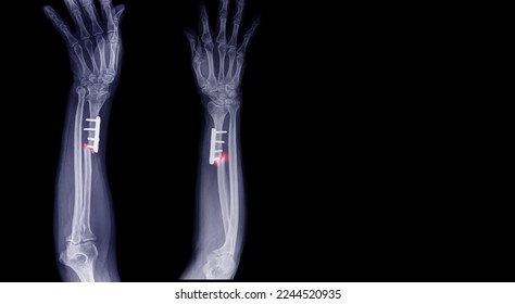 
A forearm x-ray shows an accidental fracture of the forearm. Front and side display - Shutterstock ID 2244520935