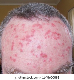 Forehead Of 56 Year Old Male In Recovery Phase From Treatment For Solar Keratosis Using Topical Chemotherapy Cream