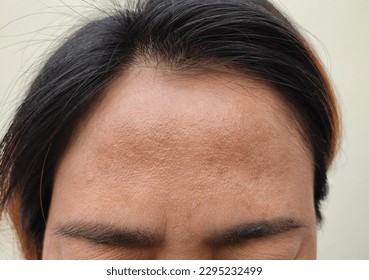 Forehead, Asian woman's face.The problem of freckles, dark spots and wrinkles on the faces of middle-aged women stressed expression, frowning, darkened face and face healthy concept.