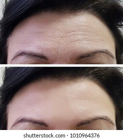forehead women wrinkles before and after

