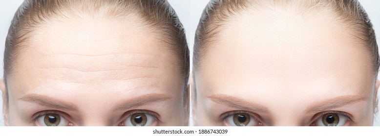 Forehead wrinkles before and after injection, treatment, surgery. Womans face close up. - Shutterstock ID 1886743039