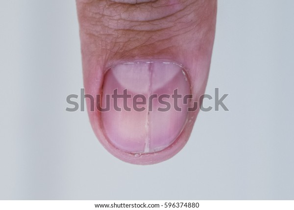 Forked nail on the thumb.\
Dilation of the nail, traumatic pathology. The nail is divided in\
half.