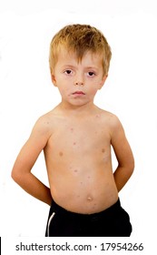Four year old with chicken pox outbreak.