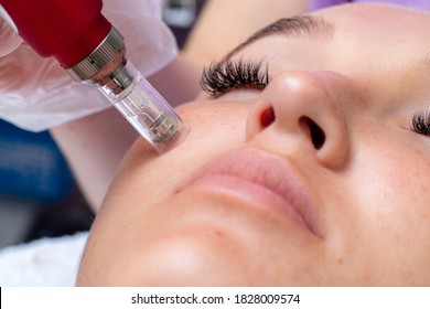 Fractional microneedle facial therapy close up