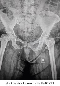 Fracture of the bilateral pubic bones