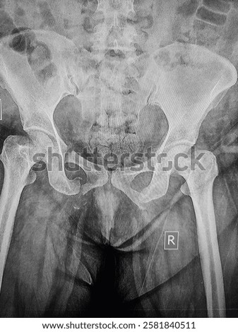 Fracture of the bilateral pubic bones