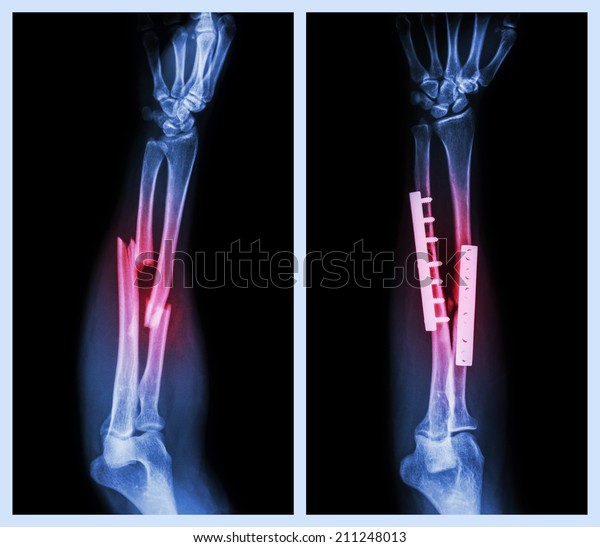 Fracture Both Bone Forearm Operated Internal Stock Photo (Edit Now ...