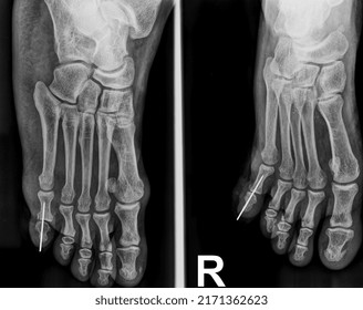 Fracture digiti pedis is a disorder of the musculoskeletal system in the lower extremities that causes damage to soft tissues, ligaments, muscles, and continuity of the digiti pedis bone which is usua
