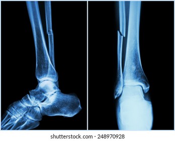 Fracture fibula ( leg bone ) .  X-ray of leg ( 2 position : side and front view )