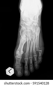 Fracture Of The Foot: The Smallest Finger