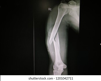  fracture of humerus 