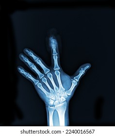 Fracture  index finger. Film x-ray AP finger - Shutterstock ID 2240016567