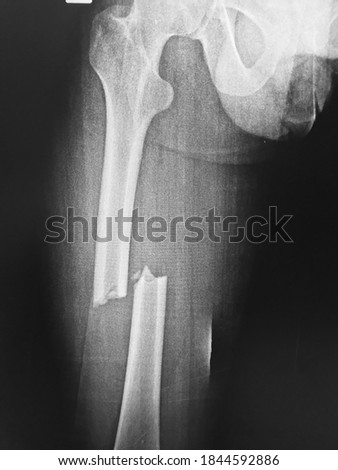  fracture left femur and blank area