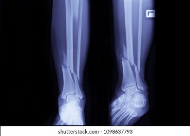 Royalty Free Fracture X Ray Stock Images Photos Vectors
