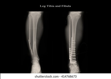 Fracture Left Leg Tibia And Fibula