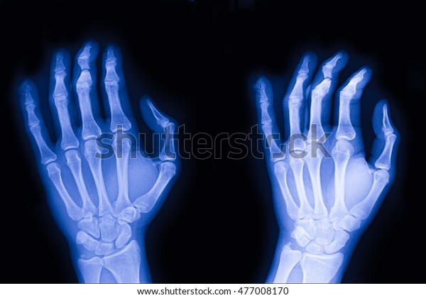Fracture Middle Finger Left Hand Stock Photo Edit Now 477008170
