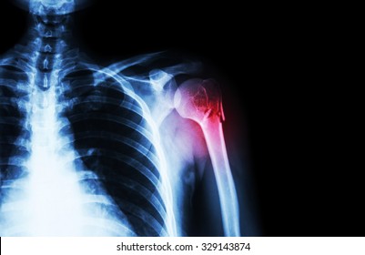 Fracture At Neck Of Humerus ( Arm Bone ) ( Film X-ray Left Shoulder And Blank Area At Right Side )