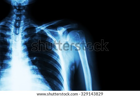 Fracture at neck of humerus ( arm bone ) ( film x-ray left shoulder and blank area at right side )