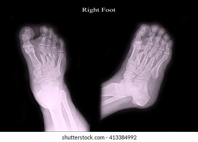 Fracture Right Foot Stock Photo (Edit Now) 413385013