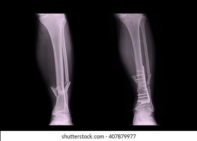 right leg tibia and fibula fracture icd 10