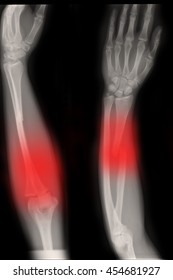 Fracture Shaft Radius Ulnar Bone Right Stock Photo 454681927 | Shutterstock