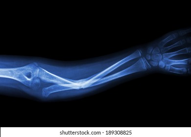 Fracture Ulnar Bone (forearm Bone)