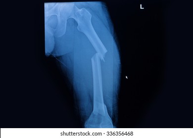 Fractured Femur, Broken Leg X-rays Image