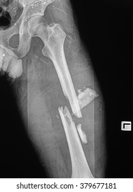 Fractured Femur, Broken Leg X-rays Image
