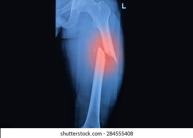 Fractured Femur, Broken Thigh X-rays Image