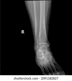 Fractures Of Distal Tibia And Fibula X-ray View.Broken Leg Radiography.