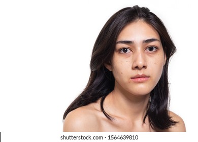 Freckles, Blemish, Pimple, Acne And Dull Skin On Her Beautiful Asian Face. Asian Woman Gets Sad, Beautiful Young Woman Get Problems Of Skin. She Look Unhappy. Were Naked. Isolated On White, Copy Space