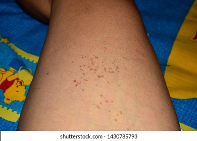 Dark Spots On Legs High Res Stock Images Shutterstock https www shutterstock com image photo freckles dark spots that occur on 1430785793