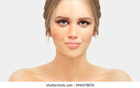 Freckles. Model's Face Divided In Two Parts