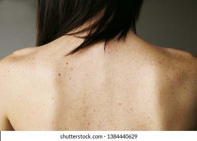 Freckles And Moles On The Girl's Back