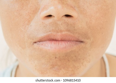 Asian Woman Spotty Skin Deep Pores Stock Photo 1439265668 