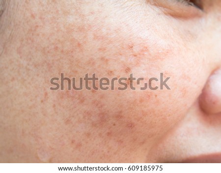 Freckles on the face.