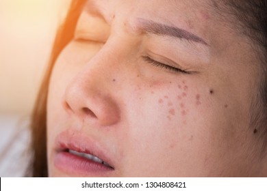 Freckles on the face of women caused by sunlight.Freckles on Asian Woman Face, Skin Problems.