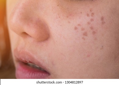 Freckles on the face of women caused by sunlight.Freckles on Asian Woman Face, Skin Problems.