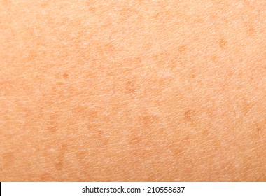 Freckles On Human Skin