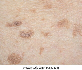 Age Spots Skin Images Stock Photos Vectors Shutterstock