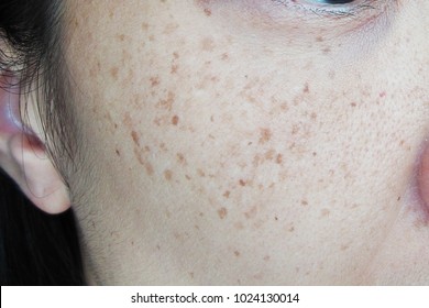 Freckles Over Asian Woman Face, Skin Problems