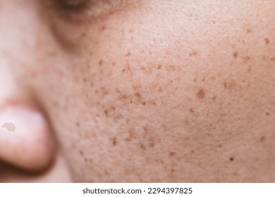 Freckles Over Asian Woman Face,Skin Problems
