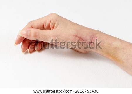 A fresh healing scar one month after surgery on tendons and radial nerve. Scar care. Female hand lying white linen background