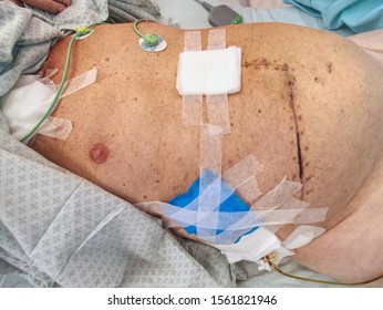 Fresh Postoperative Scar Sewn With Silver Thread. Patient After Intestinal And Gall Bladder Cancer.